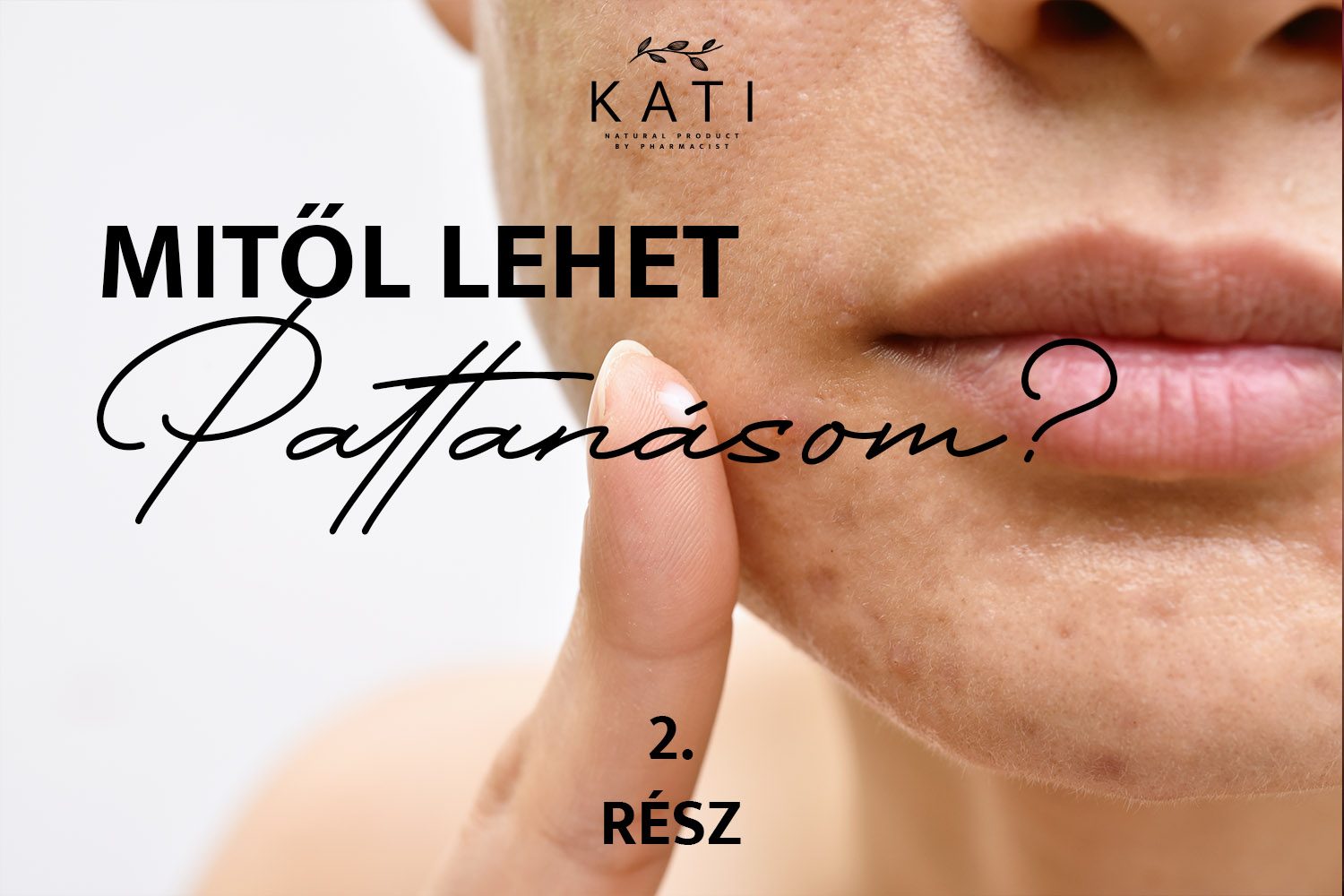 Mitől Lehet Pattanásom? 2.Rész